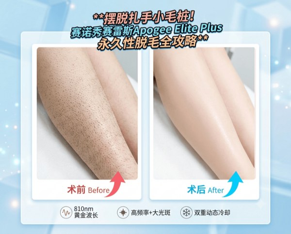 10 years of shaving and leg hair just gets thicker, turning into dark stubble? | Complete guide to Korea’s Apogee Elite Plus – permanent hair follicle targeting with high frequency + large spot size
