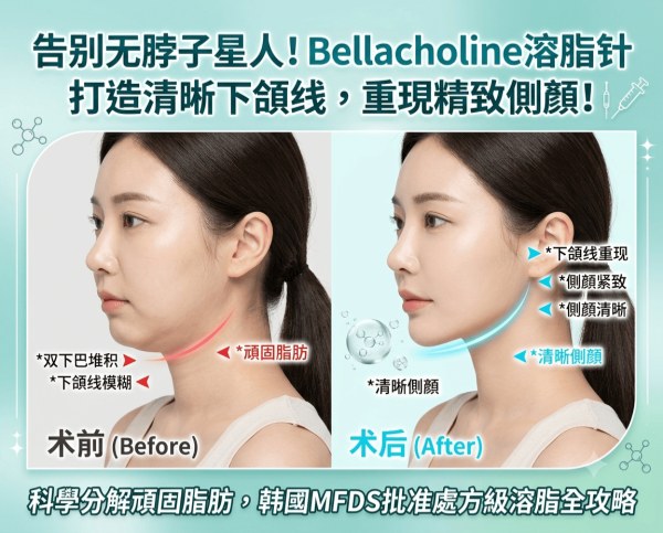 Always tucking your chin for profile photos, spending half an hour retouching your jawline? | Complete guide to Korea’s Bellacholine fat-dissolving injection – breaking down stubborn fat with deoxycholic acid for a defined profile
