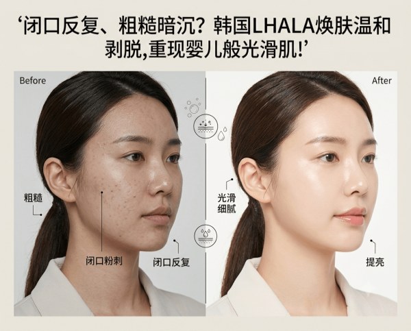 Rough, dull skin and persistent closed comedones? | Complete guide to Korea’s LHALA Peel – gentle lactic acid exfoliation for baby‑soft skin
