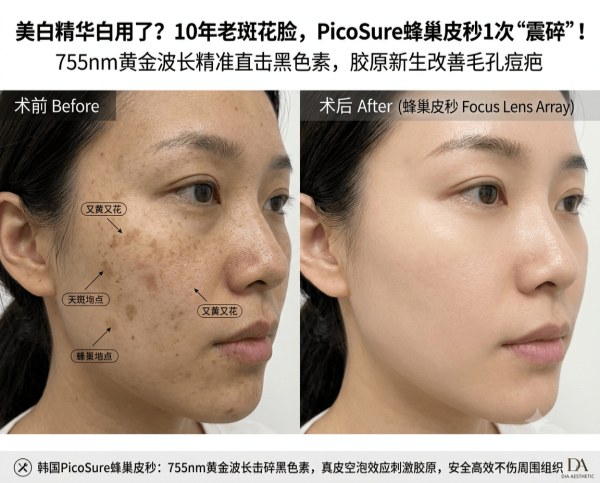 10 years of whitening serums, yet your skin is still yellow and blotchy? | Complete guide to Korea’s PicoSure – shattering melanin from within with the 755nm “golden wavelength”