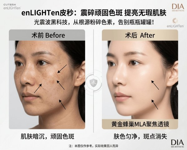 Years of using brightening serums, yet spots become more noticeable? | Complete guide to Korea’s enLIGHTen Pico – painlessly shattering stubborn pigment with photoacoustic waves