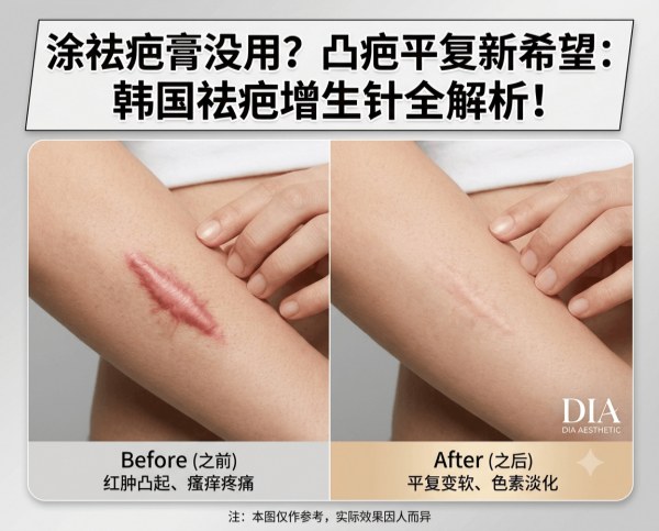 Used so many scar creams yet raised scars keep getting wider? | Complete guide to Korea’s scar injection – breaking down collagen from within to soften and flatten