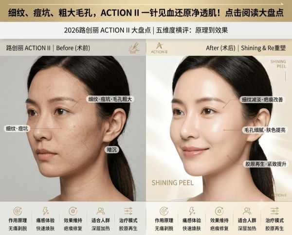 2026 Lutronic ACTION II Overview: Fine Lines · Acne Scars · Large Pores – One Guide to Improvement Effects