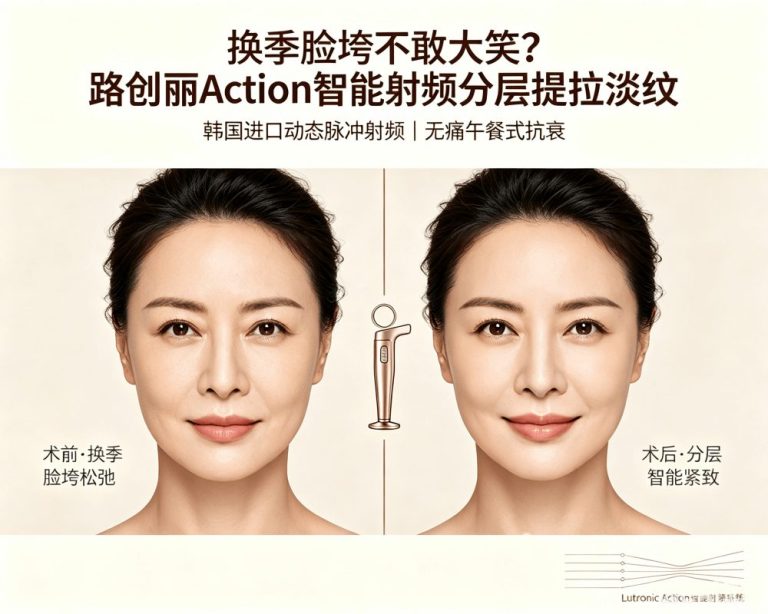 Seasonal Sagging Makes You Afraid to Laugh? Korean Lutronic Action Smart RF – Dynamic Pulse Layered Tightening