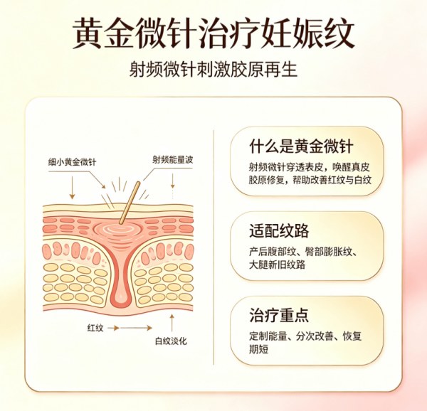 妊娠纹困扰怎么办？韩国黄金微针（Golden Microneedle RF）真实效果与价格｜2026首尔皮肤科完整攻略