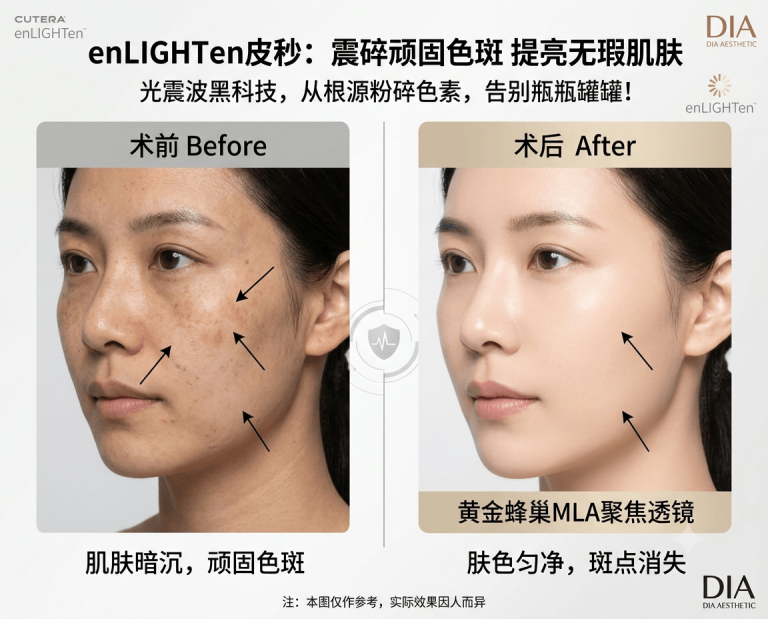 淡斑精华用了好几年，斑点反而越盖越明显？｜韩国enLIGHTen皮秒如何用光震波无痛粉碎顽固色素？